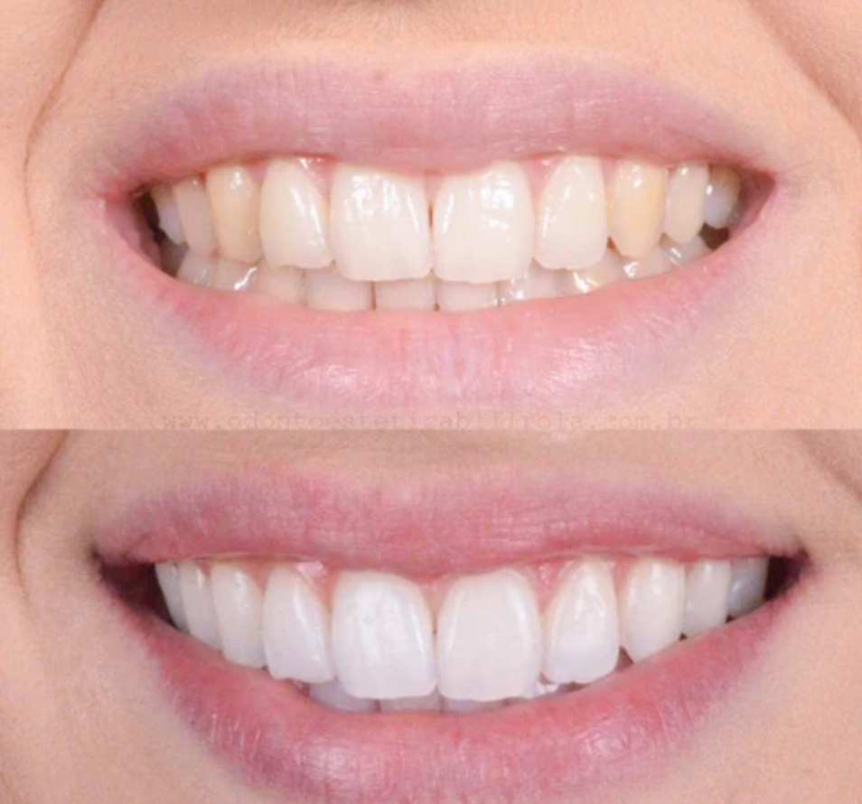 Teeth Whitening Pen – Clinically-inspired whitening at home