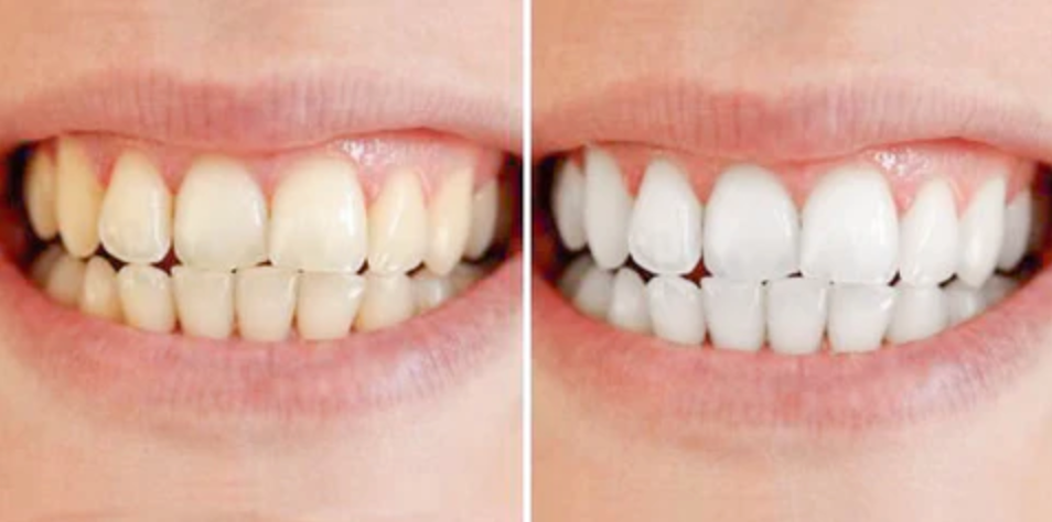 Teeth Whitening Pen – Clinically-inspired whitening at home