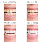 GlowSmile™ – Ultraljudsrengöring