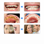 GlowSmile™ – Ultraljudsrengöring