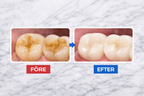 GlowSmile™ – Ultraljudsrengöring