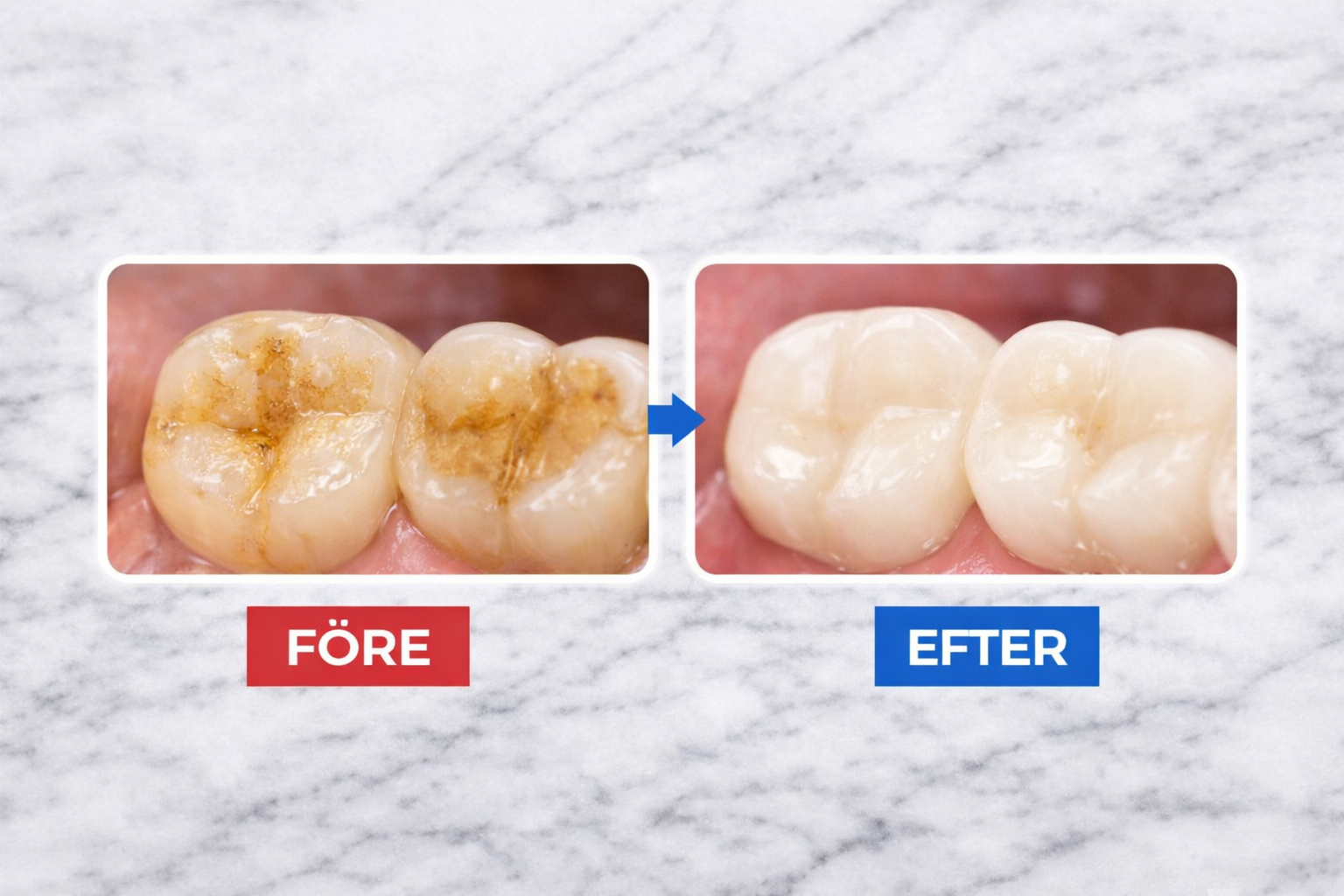 GlowSmile™ – Ultraljudsrengöring