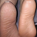SmoothHeel™ Elektrisk fotfil och nagelfil 2-i-1