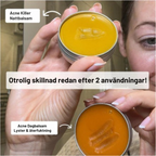 Acne Killer Kit – Effektivt mot Finnar, Rodnad & Porer