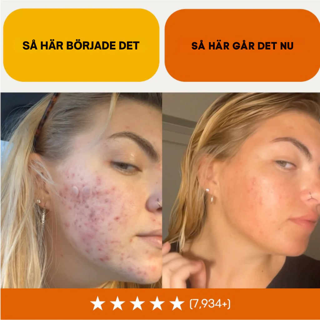 Acne Killer Kit – Effektivt mot Finnar, Rodnad & Porer