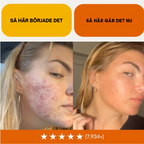 Acne Killer Kit – Effektivt mot Finnar, Rodnad & Porer